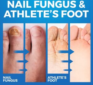 Fig.2: Athlete foot Infection