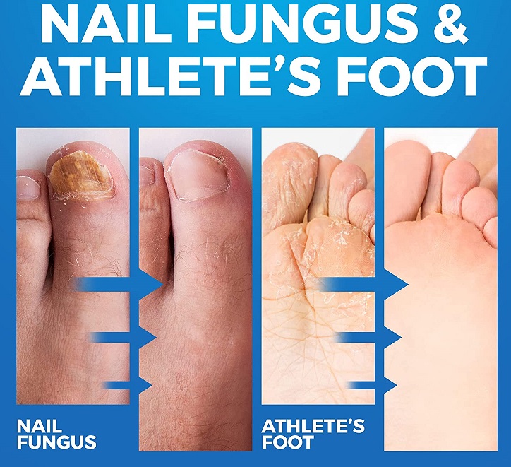 Fungal Infections Causes Symptoms Treatment Guide Fungal Infections Causes Symptoms Treatment Guide
