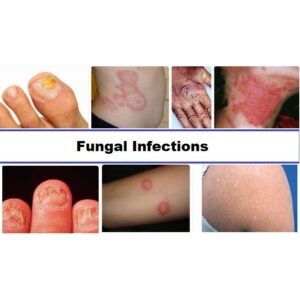 Fungal Infections - IIMT University Official Blog - Explore more!