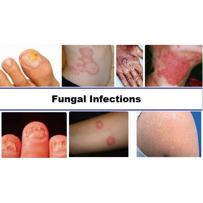 Fungal Infections Iimt University Official Blog
