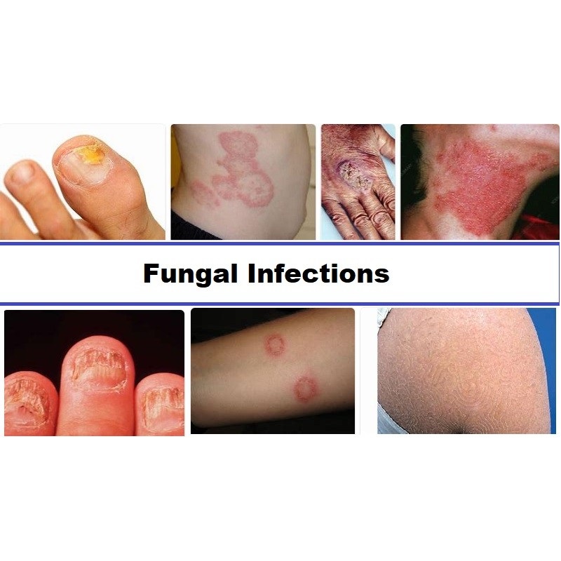 New Fungal Infection 2024 Thia Sharia