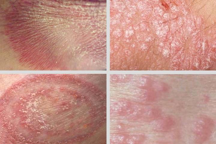 Fungal Infections Causes Symptoms Treatment Guide Fungal Infections Causes Symptoms Treatment Guide